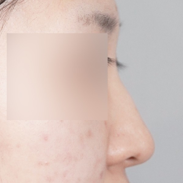 코끝,비중격,귀연골,매부리,복코,절골,비순각