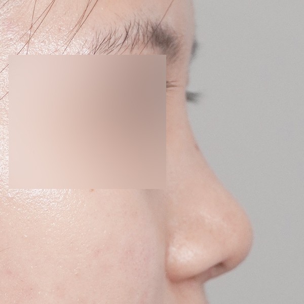 콧대,코끝,핏미,비중격,귀연골,복코,짧은코