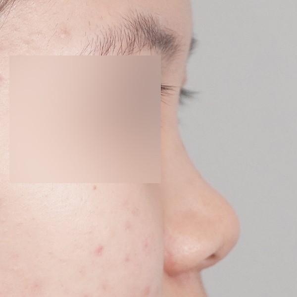 콧대,코끝,핏미,비중격,귀연골,복코,짧은코