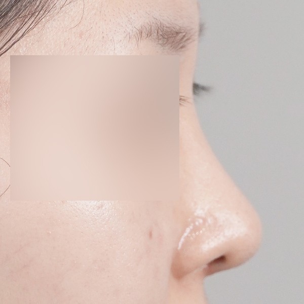 코끝,비중격,귀연골,매부리,복코,절골,비순각